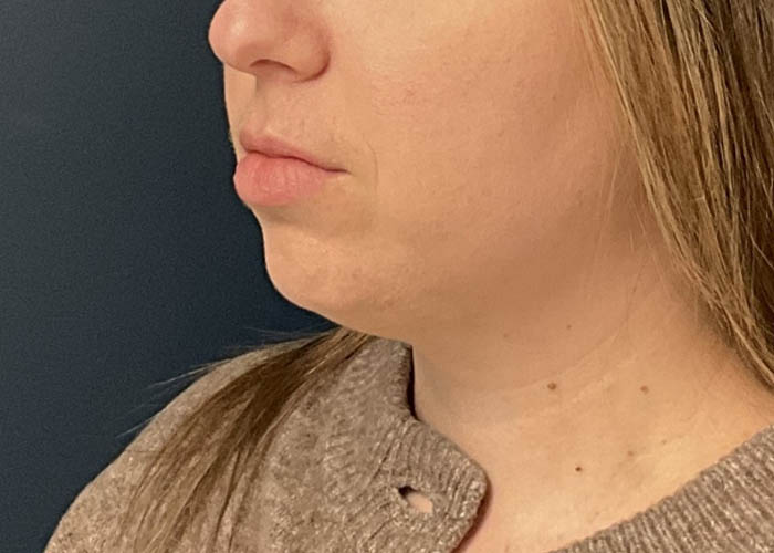 Chin Liposuction case #15438