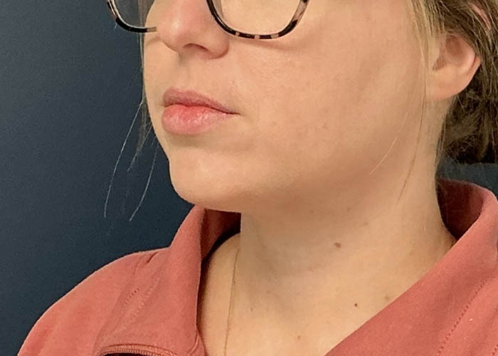 Chin Liposuction case #15438