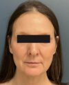 Facelift case #15431