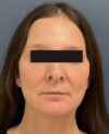 Facelift case #15431