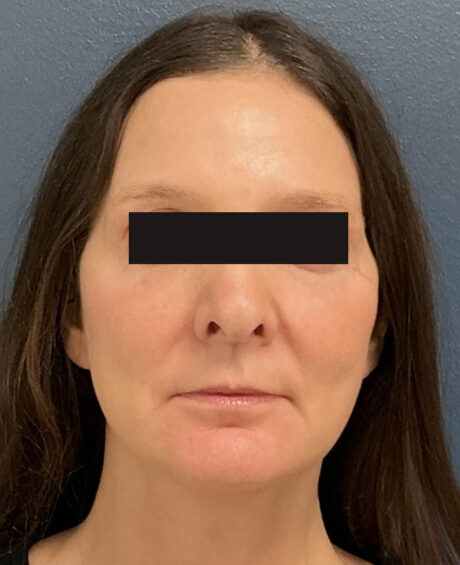 Facelift case #15431