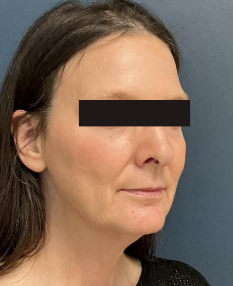 Facelift case #15431