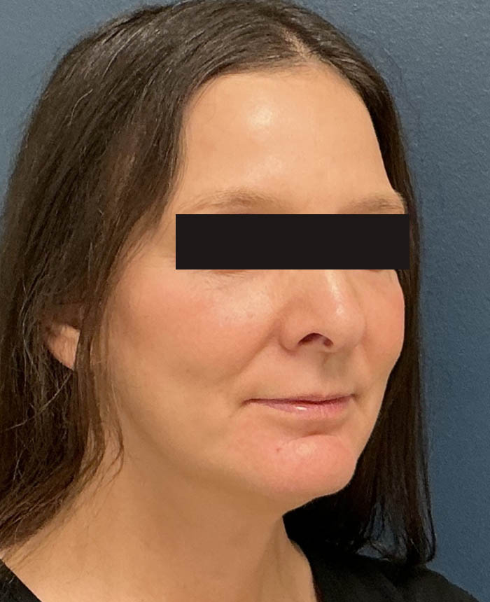 Facelift case #15431