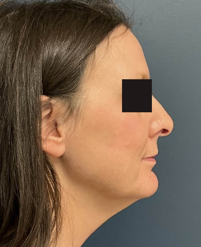 Facelift case #15431