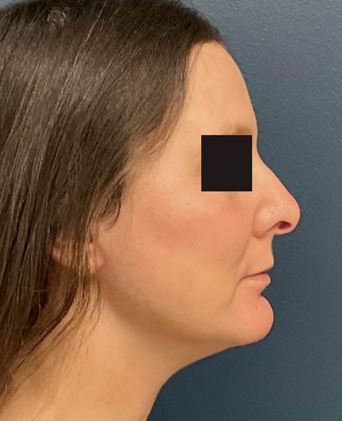 Facelift case #15431