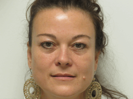 BOTOX® Cosmetic case #15899