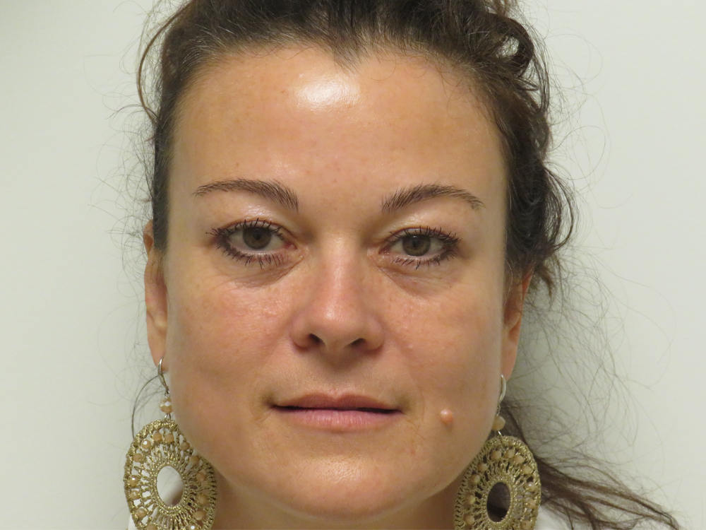 BOTOX® Cosmetic case #15899