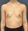 Breast Augmentation case #15892