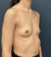Breast Augmentation case #15892