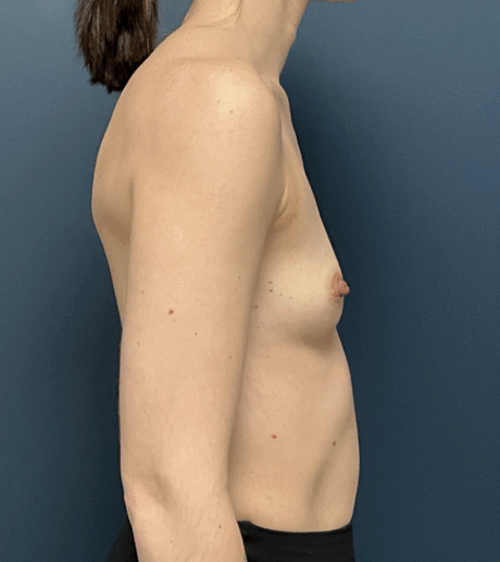 Breast Augmentation case #15892