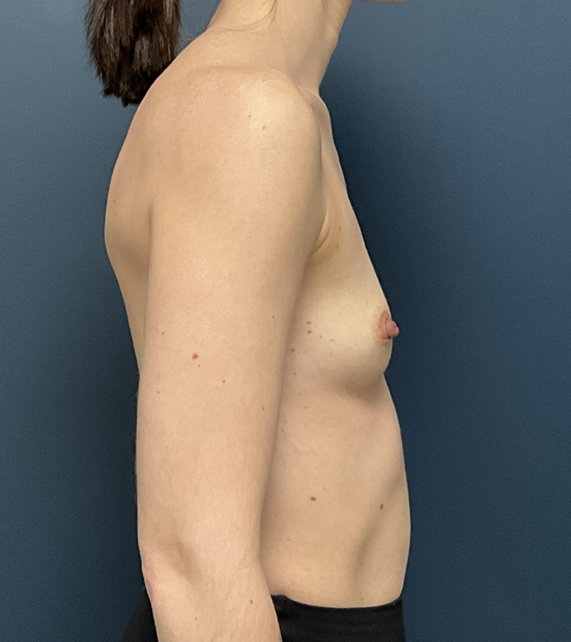 Breast Augmentation case #15892