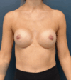 Breast Augmentation case #15892