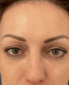 Eyelid Surgery case #15880