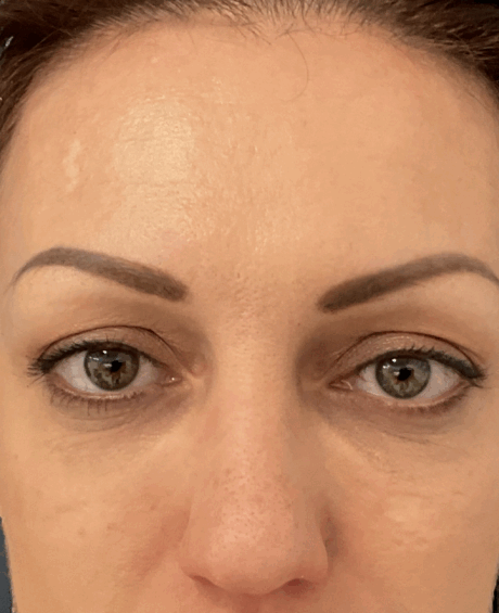 Eyelid Surgery case #15880