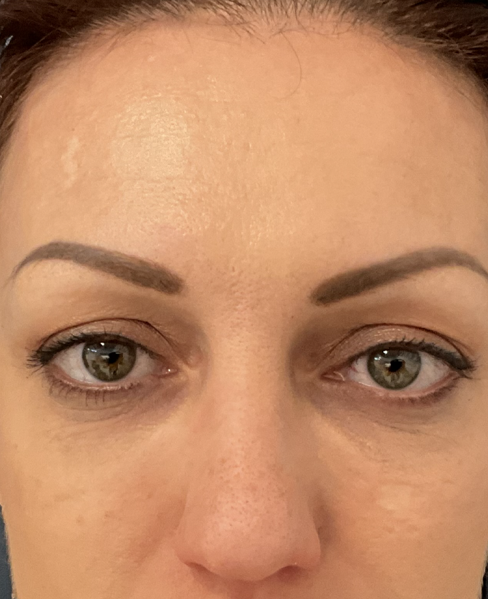 Eyelid Surgery case #15880