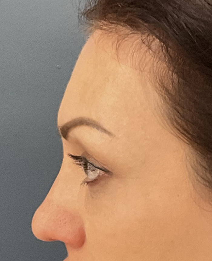 Eyelid Surgery case #15880