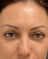 Eyelid Surgery case #15880