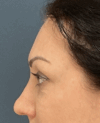 Eyelid Surgery case #15880
