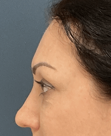 Eyelid Surgery case #15880
