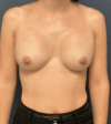 Breast Revision case #15885