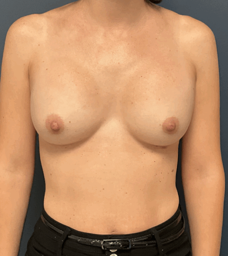 Breast Revision case #15885