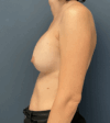Breast Revision case #15885