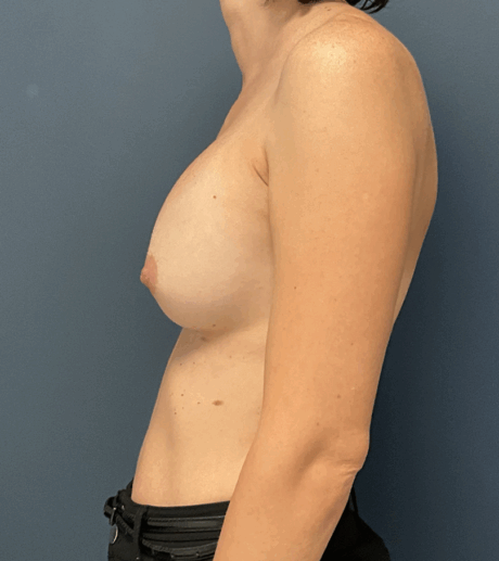 Breast Revision case #15885