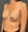 Breast Revision case #15885