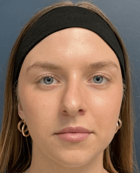 Rhinoplasty case #15866