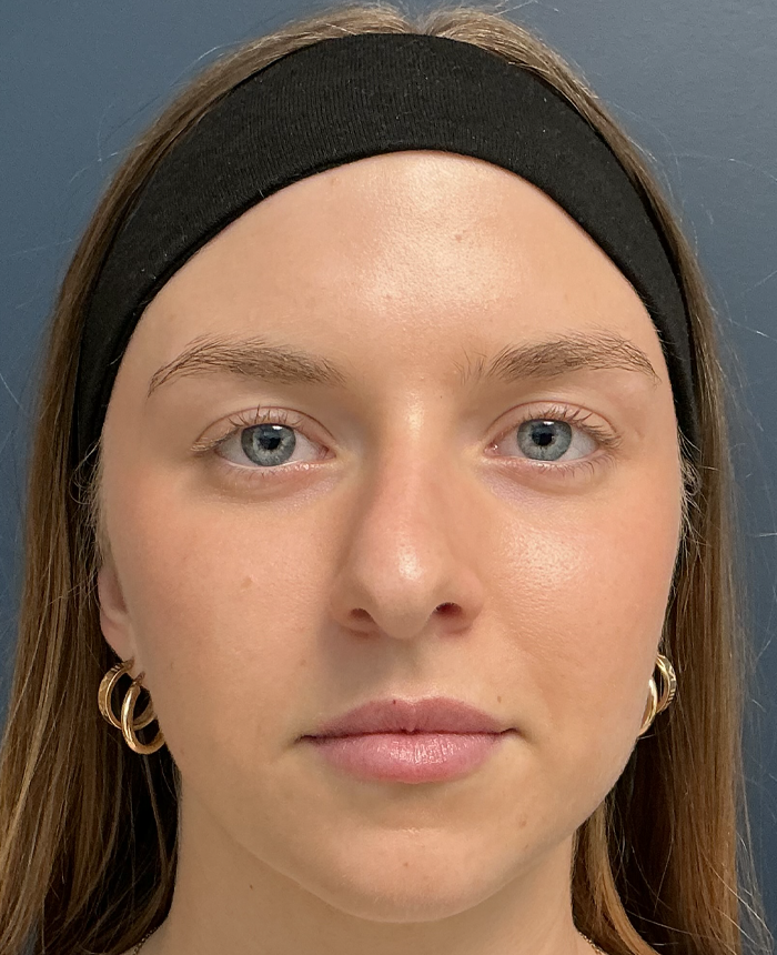 Rhinoplasty case #15866