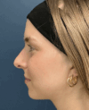 Rhinoplasty case #15866