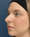 Rhinoplasty case #15866