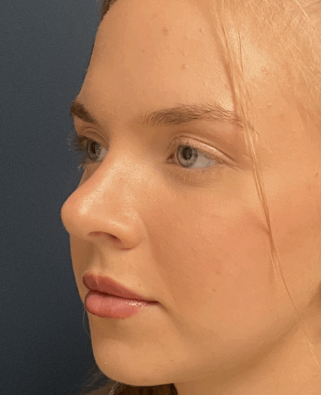 Rhinoplasty case #15866
