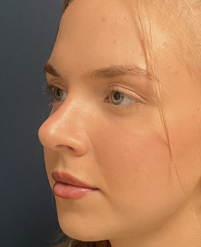 Rhinoplasty case #15866