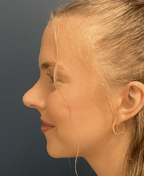 Rhinoplasty case #15866