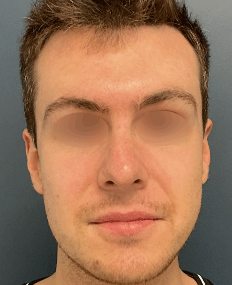 Rhinoplasty case #15858