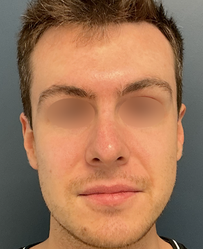 Rhinoplasty case #15858