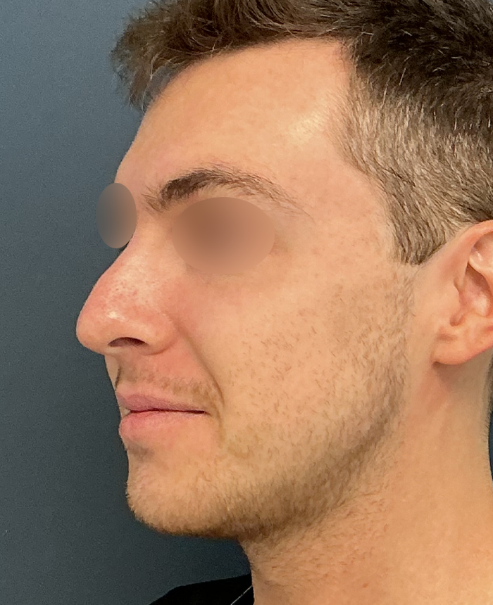 Rhinoplasty case #15858