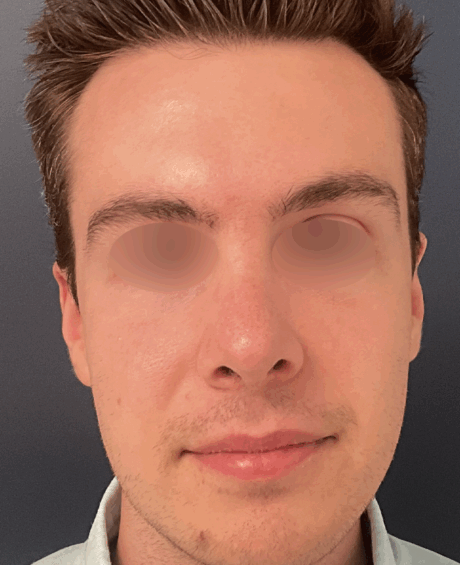 Rhinoplasty case #15858