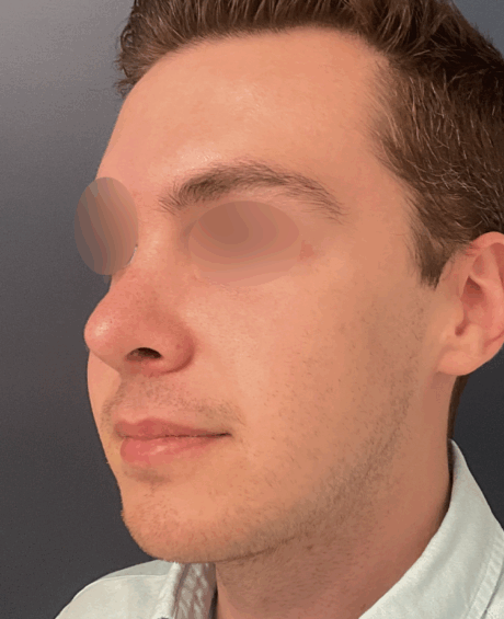 Rhinoplasty case #15858