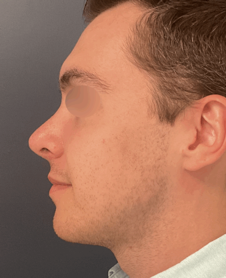 Rhinoplasty case #15858