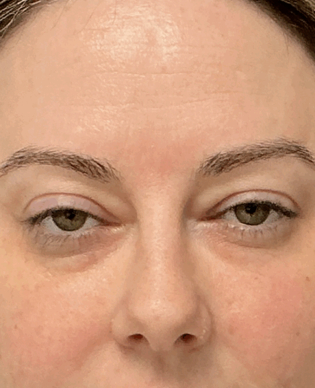 Eyelid Surgery case #15873