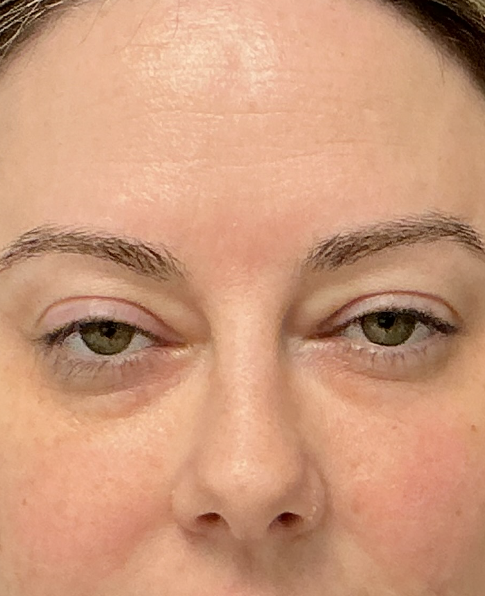 Eyelid Surgery case #15873