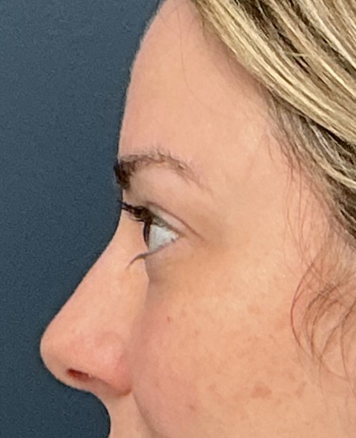 Eyelid Surgery case #15873