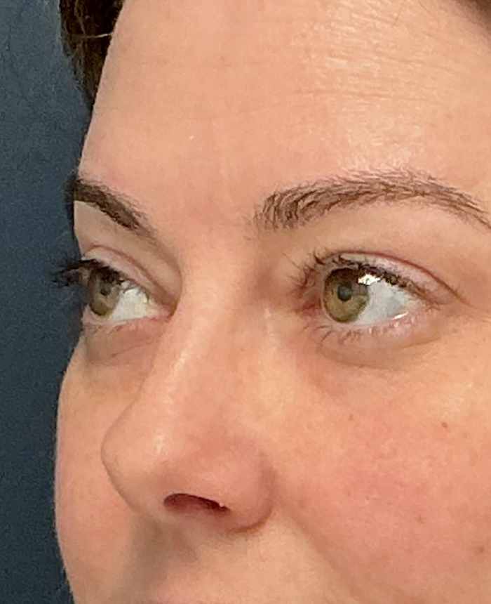 Eyelid Surgery case #15873