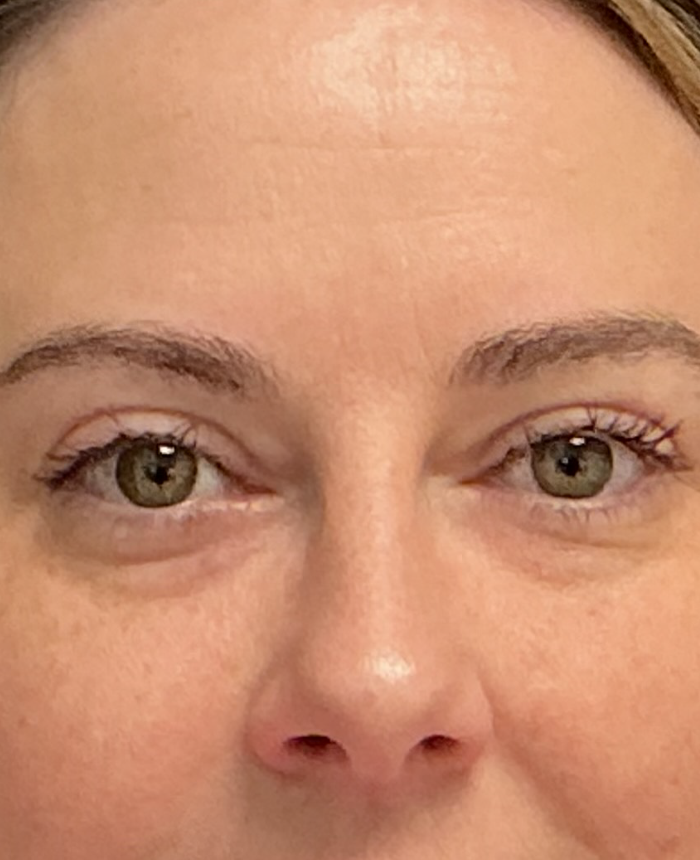 Eyelid Surgery case #15873