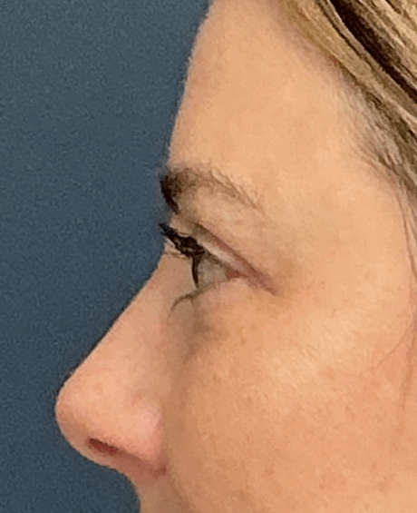 Eyelid Surgery case #15873