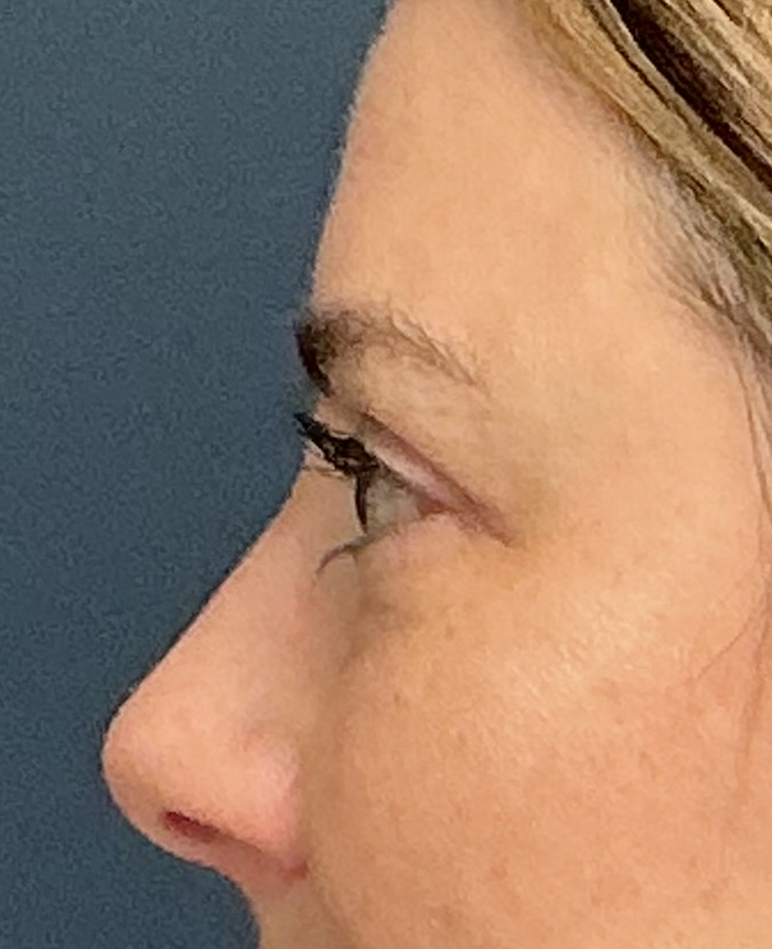 Eyelid Surgery case #15873