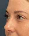 Eyelid Surgery case #15873