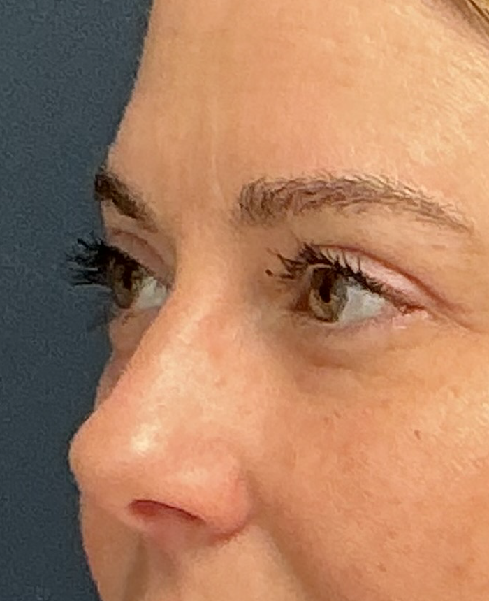 Eyelid Surgery case #15873